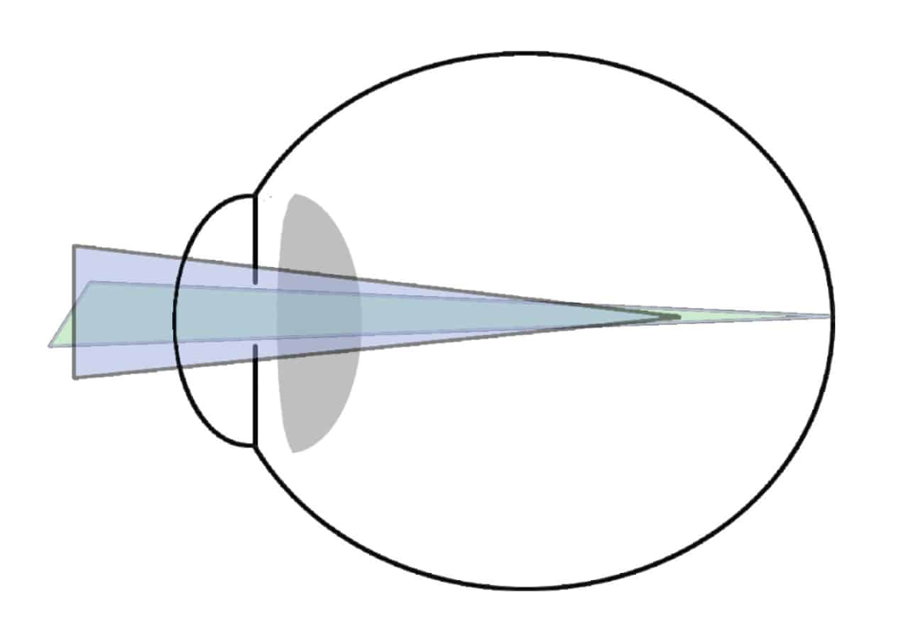 Astigmatismo miópico simple